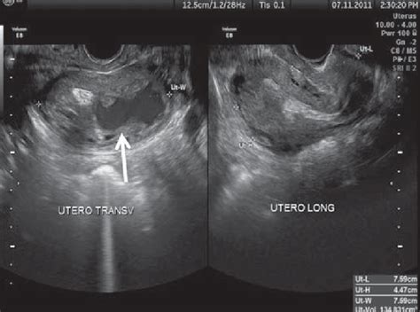 Spotting between periods. . Is a heterogeneous uterus bad